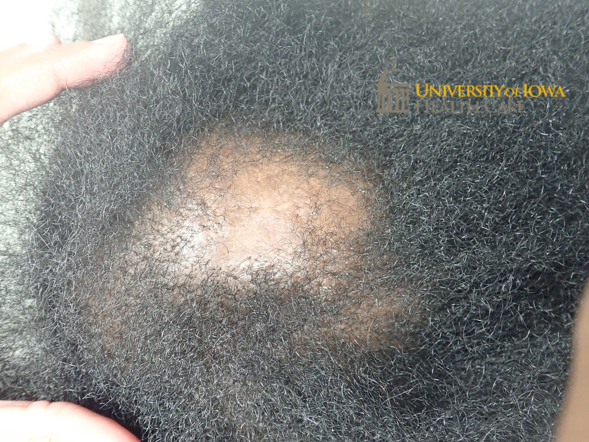 Circular patch of scarring alopecia with some retained hair follicles on the anterior scalp. (click images for higher resolution).